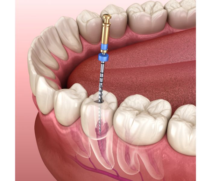 Endodoncista en Vilafranca del Penedés